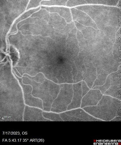 Retinal Arterial Macroaneurysm with pre-retinal hemorrhage
72 year old female who takes Xarelto had sudden vision loss while moving heavy furniture.  VA was 20/200.  The lesion has preretinal blood but later rebled with subretinal blood, was lasered and the final vision was not very good but the patient was lost to follow-up at 3 months
