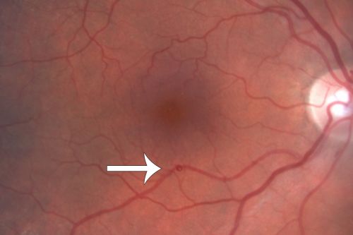 Retinal Arterial Macroaneurysm - Normal Vision (2 Years before rupture)
78-year-old woman has a retinal arterial macroaneurysm in the right eye.  VA 20/25 (pre-rupture photos)
