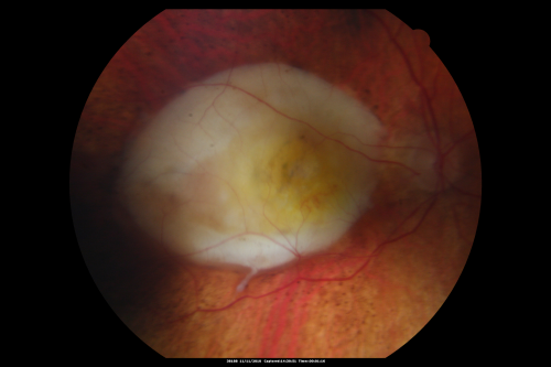 Disciform Scar after Photodynamic Laser - Macular Hemorrhage and Vitrectomy
84-year-old man has age-related macular degeneration in both eyes, with a disciform scar in the right eye.  He had a subfoveal hemorrhage in that eye treated with vitrectomy and displacement on May 3, 2006.  He previous to that had photodynamic laser.  These photos are from October 2010.  VA is 1/200.
Schlüsselwörter: scar;amd;disciform
