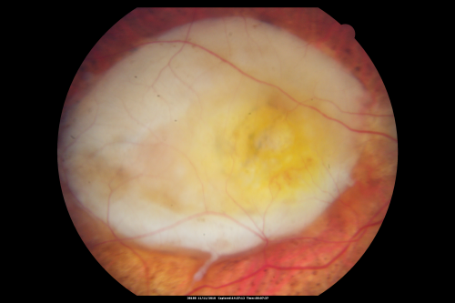 Disciform Scar after Photodynamic Laser - Macular Hemorrhage and Vitrectomy
84-year-old man has age-related macular degeneration in both eyes, with a disciform scar in the right eye.  He had a subfoveal hemorrhage in that eye treated with vitrectomy and displacement on May 3, 2006.  He previous to that had photodynamic laser.  These photos are from October 2010.  VA is 1/200.
Keywords: scar;amd;disciform