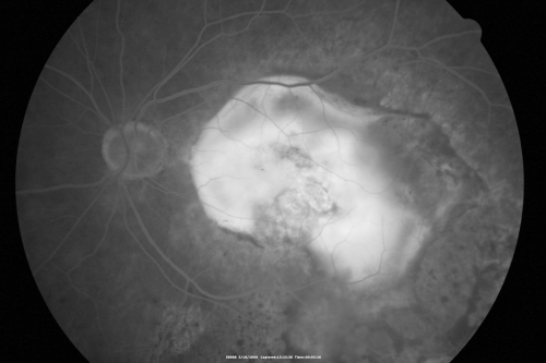 Macular Scar Left Eye from Age-Related Macular Degeneration
81-year-old woman has a macular scar in the left eye and then unfortunately developed a central retinal artery occlusion in the right eye  OD 20/100, OS 6/200.
