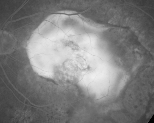 Macular Scar Left Eye from Age-Related Macular Degeneration
81-year-old woman has a macular scar in the left eye and then unfortunately developed a central retinal artery occlusion in the right eye  OD 20/100, OS 6/200.
