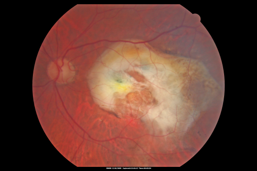 Macular Scar Left Eye from Age-Related Macular Degeneration
81-year-old woman has a macular scar in the left eye and then unfortunately developed a central retinal artery occlusion in the right eye  OD 20/100, OS 6/200.
