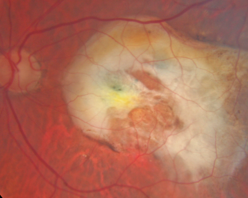 Macular Scar Left Eye from Age-Related Macular Degeneration
81-year-old woman has a macular scar in the left eye and then unfortunately developed a central retinal artery occlusion in the right eye  OD 20/100, OS 6/200.
