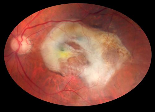 Macular Scar Left Eye from Age-Related Macular Degeneration
81-year-old woman has a macular scar in the left eye and then unfortunately developed a central retinal artery occlusion in the right eye  OD 20/100, OS 6/200.
