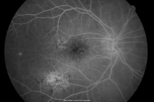 Macular Scar Left Eye from Age-Related Macular Degeneration
81-year-old woman has a macular scar in the left eye and then unfortunately developed a central retinal artery occlusion in the right eye  OD 20/100, OS 6/200.
