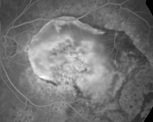 Macular Scar Left Eye from Age-Related Macular Degeneration
81-year-old woman has a macular scar in the left eye and then unfortunately developed a central retinal artery occlusion in the right eye  OD 20/100, OS 6/200.
