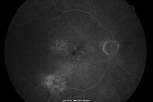 Macular Scar Left Eye from Age-Related Macular Degeneration
81-year-old woman has a macular scar in the left eye and then unfortunately developed a central retinal artery occlusion in the right eye  OD 20/100, OS 6/200.
