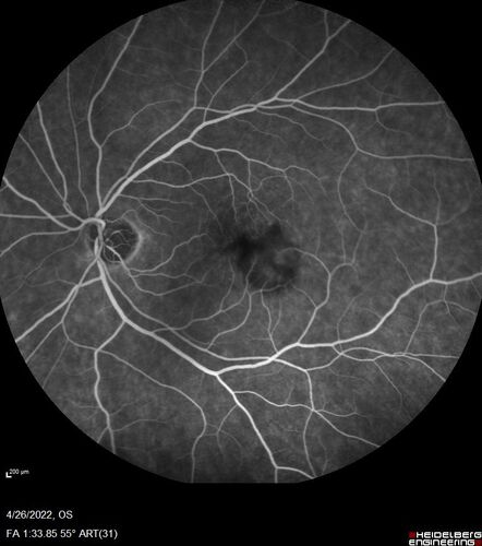 Macular Serpiginous Chorioretinopathy
75 year old vision with central placoid lesions.  She tested negative for TB and Syphilis.  The final visual acuity in both eyes was 1/200.
