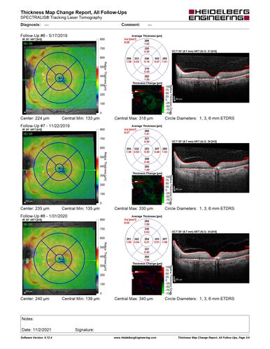 Stage V (neovascular) Macular Telangiectasia - Fluorescein
67 year old female with vision in only the left eye.  She has mild CNVM which is treated with Avastin and does well over several  years.
