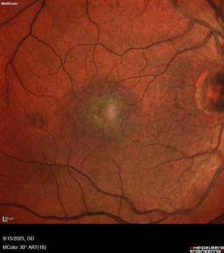 MacTel with foveal atrophy in both eyes
62 year old female with 20/50 OD, 20/40 OS.
