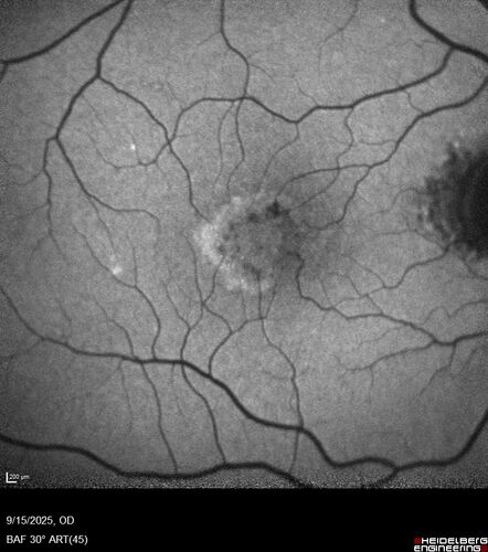 MacTel with foveal atrophy in both eyes
62 year old female with 20/50 OD, 20/40 OS.
