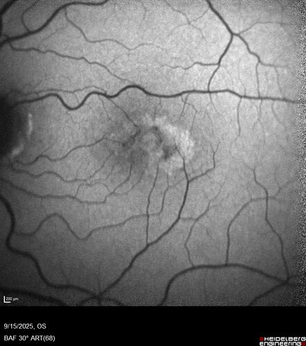 MacTel with foveal atrophy in both eyes
62 year old female with 20/50 OD, 20/40 OS.
