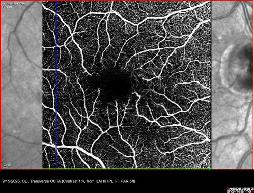 MacTel with foveal atrophy in both eyes
62 year old female with 20/50 OD, 20/40 OS.
