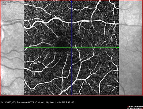 MacTel with foveal atrophy in both eyes
62 year old female with 20/50 OD, 20/40 OS.
