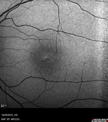 Macular Telangiectasis (MacTel)
FAF shows decrease macular pigment
