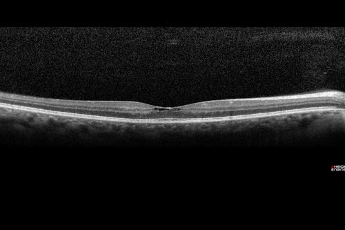 Macular Telangiectasis (MacTel)
