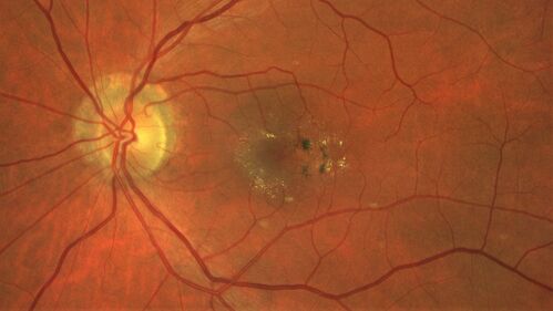 Macular telangiectasia - images from 10 years later - crystals 
75 year old man with MacTel and a lot of crystals  VA 20/63 OD, 20/50 OS.
