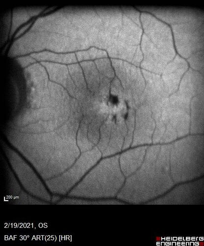 Macular telangiectasia - images from 10 years later - crystals 
75 year old man with MacTel and a lot of crystals  VA 20/63 OD, 20/50 OS.
