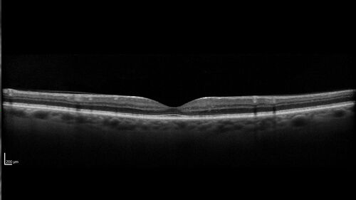 Macular telangiectasia - images from 10 years later - crystals 
75 year old man with MacTel and a lot of crystals  VA 20/63 OD, 20/50 OS.
