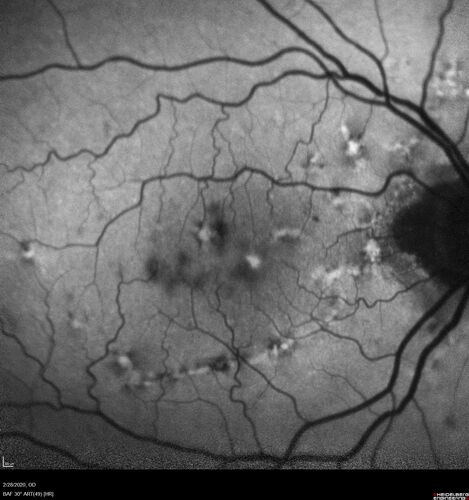 Macular Telangiectasia (MacTel) and Pattern Dystrophy
71 year old man with diabetes for 5 years and blurred vision in the left eye. VA 20/25 OD, 20/50 OS.  OCT OS shows MacTel
