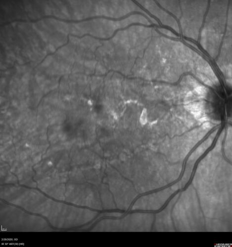 Macular Telangiectasia (MacTel) and Pattern Dystrophy
71 year old man with diabetes for 5 years and blurred vision in the left eye. VA 20/25 OD, 20/50 OS.  OCT OS shows MacTel
