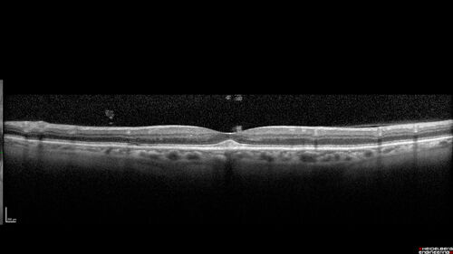 Macular Telangiectasia (MacTel) and Pattern Dystrophy
71 year old man with diabetes for 5 years and blurred vision in the left eye. VA 20/25 OD, 20/50 OS.  OCT OS shows MacTel
