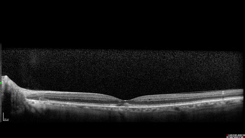 Macular Telangiectasia (MacTel) and Pattern Dystrophy
71 year old man with diabetes for 5 years and blurred vision in the left eye. VA 20/25 OD, 20/50 OS.  OCT OS shows MacTel

