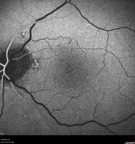 Macular Telangiectasia (MacTel) and Pattern Dystrophy
71 year old man with diabetes for 5 years and blurred vision in the left eye. VA 20/25 OD, 20/50 OS.  OCT OS shows MacTel
