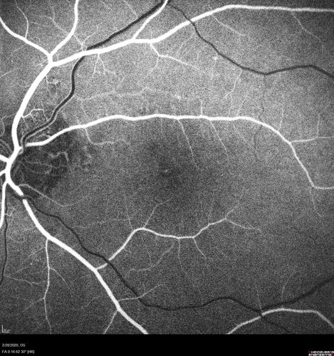 Macular Telangiectasia (MacTel) and Pattern Dystrophy
71 year old man with diabetes for 5 years and blurred vision in the left eye. VA 20/25 OD, 20/50 OS.  OCT OS shows MacTel
