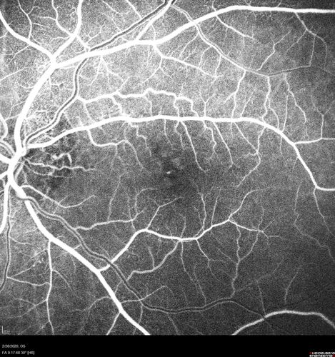 Macular Telangiectasia (MacTel) and Pattern Dystrophy
71 year old man with diabetes for 5 years and blurred vision in the left eye. VA 20/25 OD, 20/50 OS.  OCT OS shows MacTel
