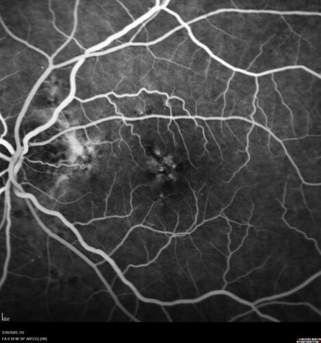 Macular Telangiectasia (MacTel) and Pattern Dystrophy
71 year old man with diabetes for 5 years and blurred vision in the left eye. VA 20/25 OD, 20/50 OS.  OCT OS shows MacTel
