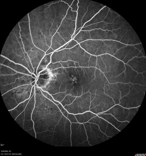 Macular Telangiectasia (MacTel) and Pattern Dystrophy
71 year old man with diabetes for 5 years and blurred vision in the left eye. VA 20/25 OD, 20/50 OS.  OCT OS shows MacTel
