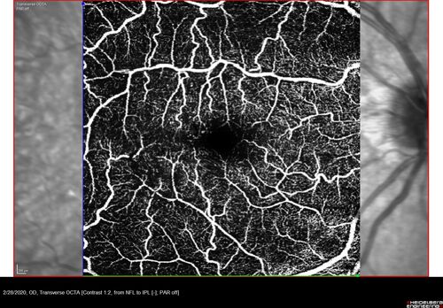 Macular Telangiectasia (MacTel) and Pattern Dystrophy
71 year old man with diabetes for 5 years and blurred vision in the left eye. VA 20/25 OD, 20/50 OS.  OCT OS shows MacTel
