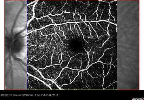 Macular Telangiectasia (MacTel) and Pattern Dystrophy
71 year old man with diabetes for 5 years and blurred vision in the left eye. VA 20/25 OD, 20/50 OS.  OCT OS shows MacTel
