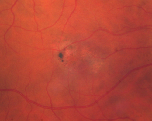 Juxtafoveal Telangiectasis - (MacTel) - Stage 4 both Eyes
57-year-old woman with a history of decreased vision.  The patient reports that her vision has been gradually decreasing in the left more so than the right eye. 20/50 OD and 20/60
