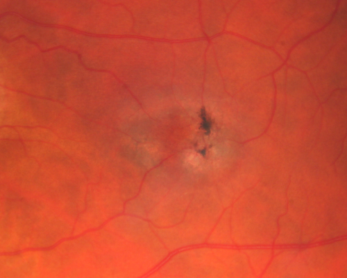 Juxtafoveal Telangiectasis - (MacTel) - Stage 4 both Eyes
57-year-old woman with a history of decreased vision.  The patient reports that her vision has been gradually decreasing in the left more so than the right eye. 20/50 OD and 20/60
