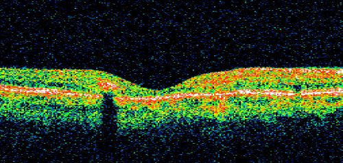 Juxtafoveal Telangiectasis - (MacTel) - Stage 4 both Eyes
57-year-old woman with a history of decreased vision.  The patient reports that her vision has been gradually decreasing in the left more so than the right eye. 20/50 OD and 20/60
