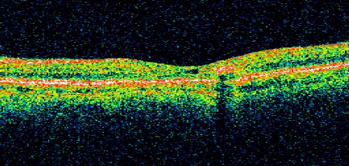Juxtafoveal Telangiectasis - (MacTel) - Stage 4 both Eyes
57-year-old woman with a history of decreased vision.  The patient reports that her vision has been gradually decreasing in the left more so than the right eye. 20/50 OD and 20/60
