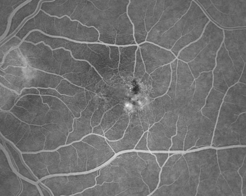 Juxtafoveal Telangiectasis - (MacTel) - Stage 4 both Eyes
57-year-old woman with a history of decreased vision.  The patient reports that her vision has been gradually decreasing in the left more so than the right eye. 20/50 OD and 20/60
