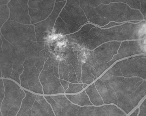 Juxtafoveal Telangiectasis - (MacTel) - Stage 4 both Eyes
57-year-old woman with a history of decreased vision.  The patient reports that her vision has been gradually decreasing in the left more so than the right eye. 20/50 OD and 20/60
