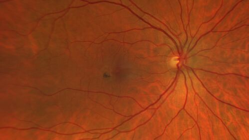 Macular Telangiectasis (MacTel) Both Eye - Stage IV - Pigment Spots
63 year old female with Type II DM x 4 years.  Vision is 20/40 both eyes.
