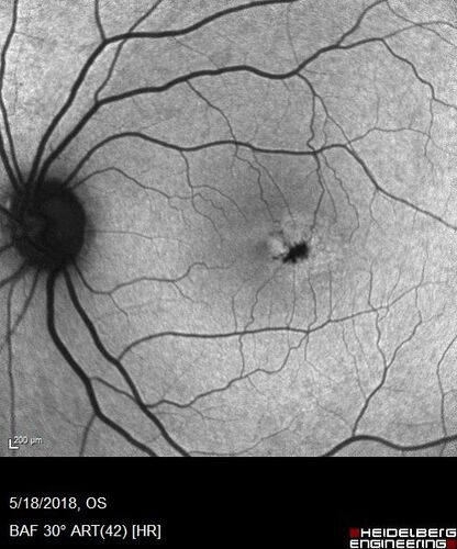 Macular Telangiectasis (MacTel) Both Eye - Stage IV - Pigment Spots
63 year old female with Type II DM x 4 years.  Vision is 20/40 both eyes.
