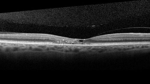 Macular Telangiectasis (MacTel) Both Eye - Stage IV - Pigment Spots
63 year old female with Type II DM x 4 years.  Vision is 20/40 both eyes.
