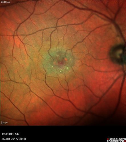 Macular Telangiectasia - Stage 3 right eye 20/40 vision
Multi-Color Image

