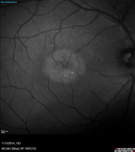 Macular Telangiectasia - Stage 3 right eye 20/40 vision - Bulls Eye Blue Reflectance
Confocal Blue Reflectance
