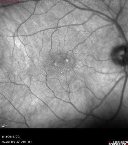 Macular Telangiectasia - Stage 3 right eye 20/40 vision
Confocal InfraRed Reflectance
