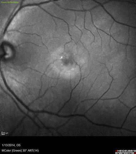 Macular Telangiectasia - Stage 5 left eye - 20/40 vision after 2 years of Avastin - Bulls Eye Blue Reflectance
Confocal Blue Reflectance

