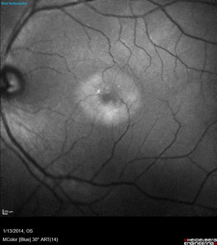 Macular Telangiectasia - Stage 5 left eye - 20/40 vision after 2 years of Avastin 
Confocal Green Reflectance
