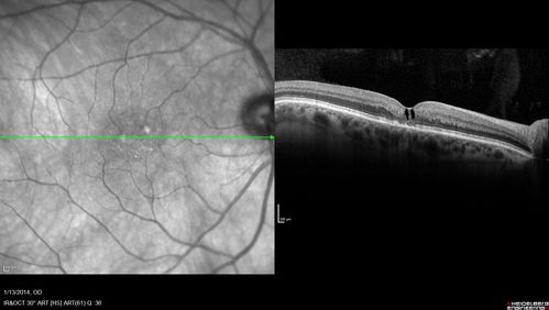 Macular Telangiectasia - Stage 3 right eye 20/40 vision
Spectral Domain OCT Line Scan
